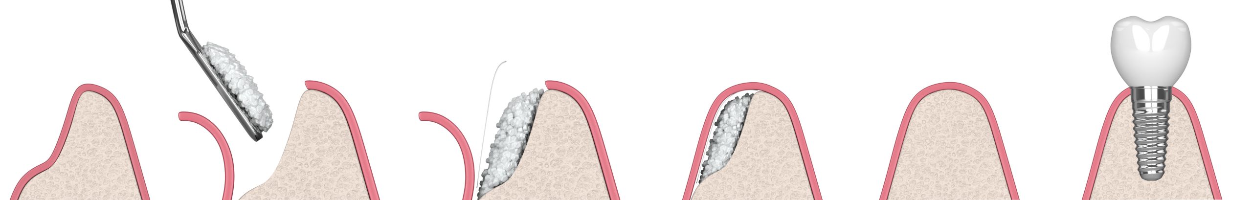 Bone Grafting